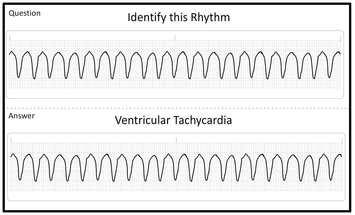 Acls Vt Rythm Rhythm Review Flashcards | Prepare ACLS/BLS exam | ACLS Certification ...