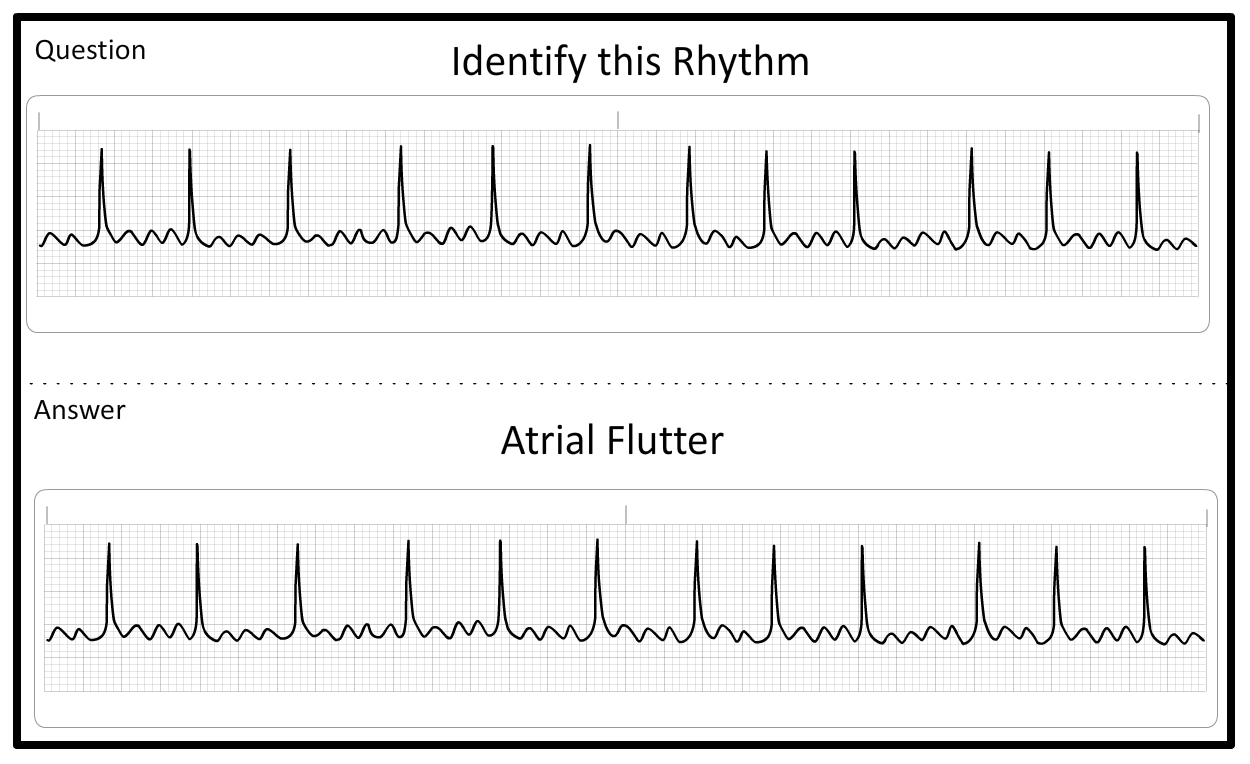 Rhythm Review Flashcards | Prepare ACLS/BLS exam | ACLS Certification ...