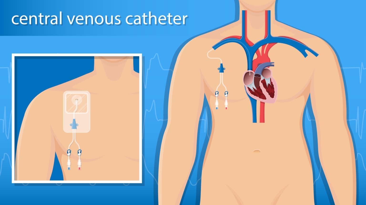 Topic - Routes for Medication Delivery | ACLS Course | ACLS ...