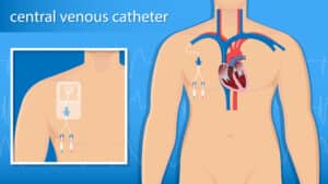 Topic - Routes for Medication Delivery | ACLS Course | ACLS ...