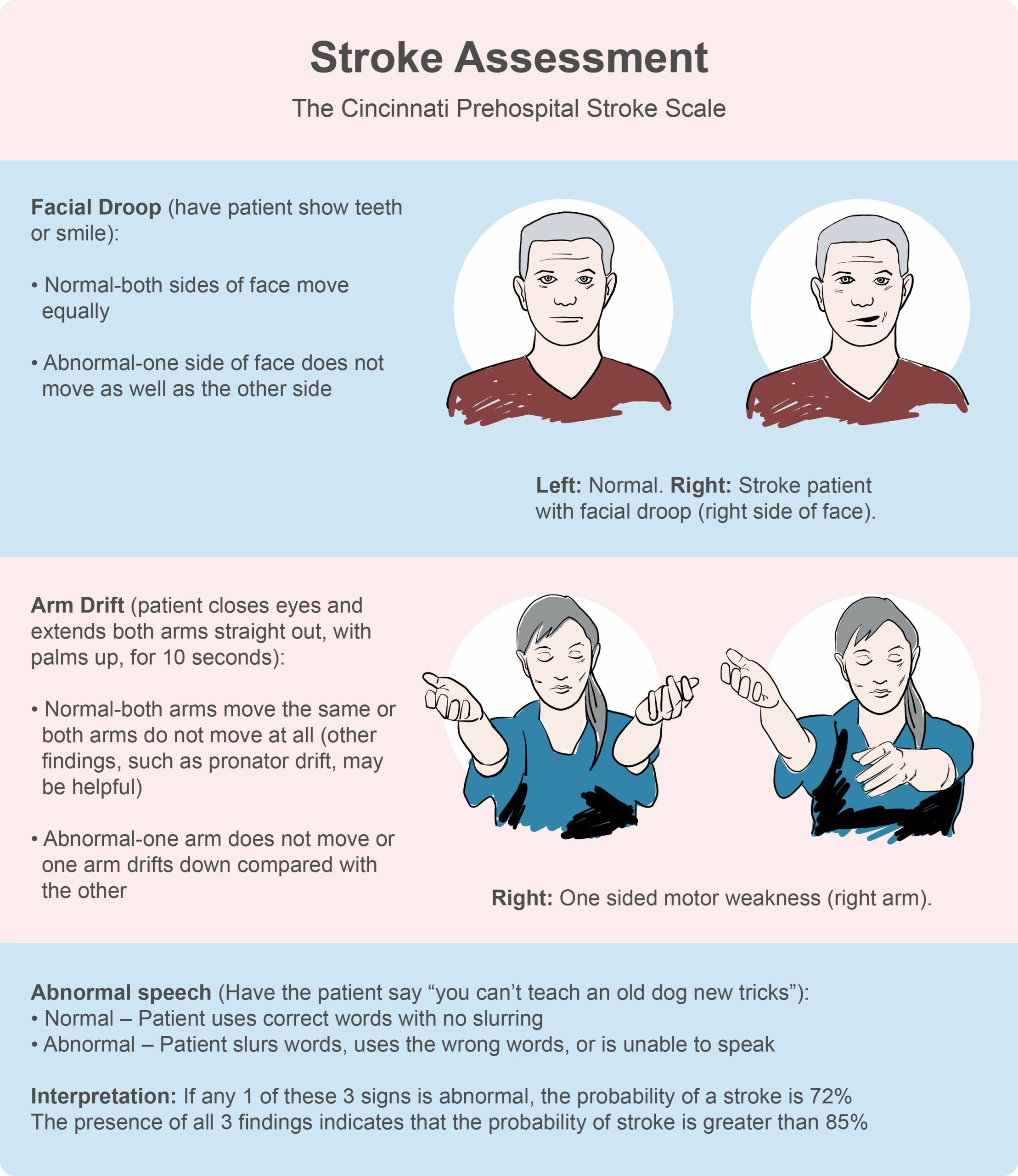 Cincinnati prehospital stroke scale.