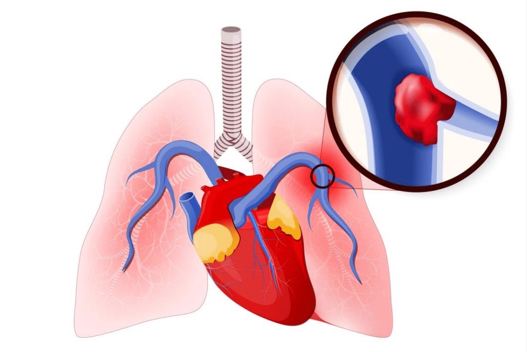 Pulmonary thrombosis occurs when blood clot is in lung artery.