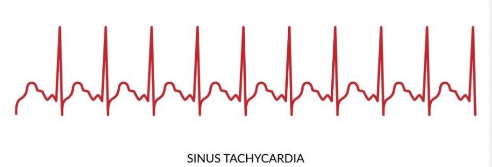  “Some causes of tachycardia are tachyarrhythmia and physiologic stress.”