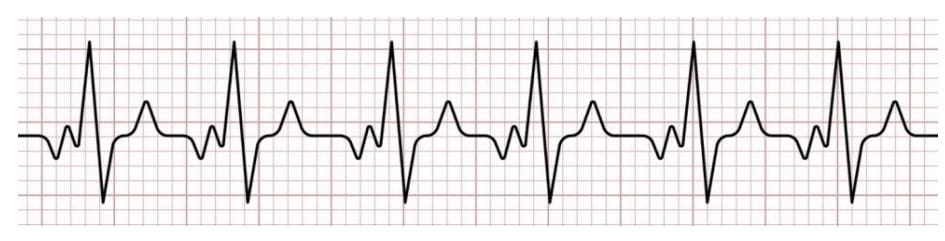 12-lead ECG evaluates heart’s electrical activity.