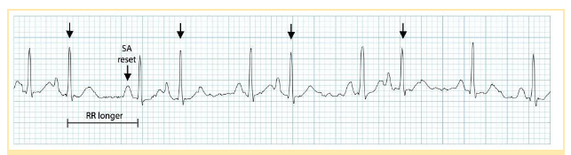 Frequent premature atrial complexes followed by brief pauses.