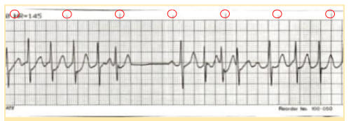 ECG strip with one-second markers.