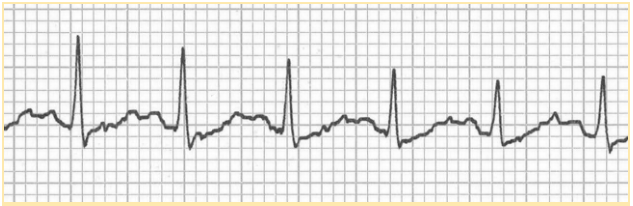 Heart rate ECG per question.
