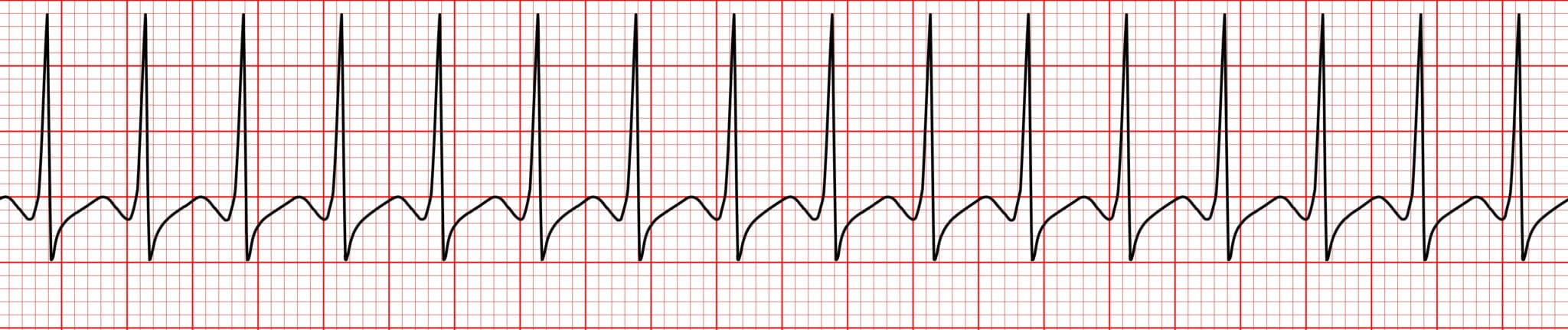 Topic - Supraventricular Tachycardia | Arrhythmia Interpretation ...
