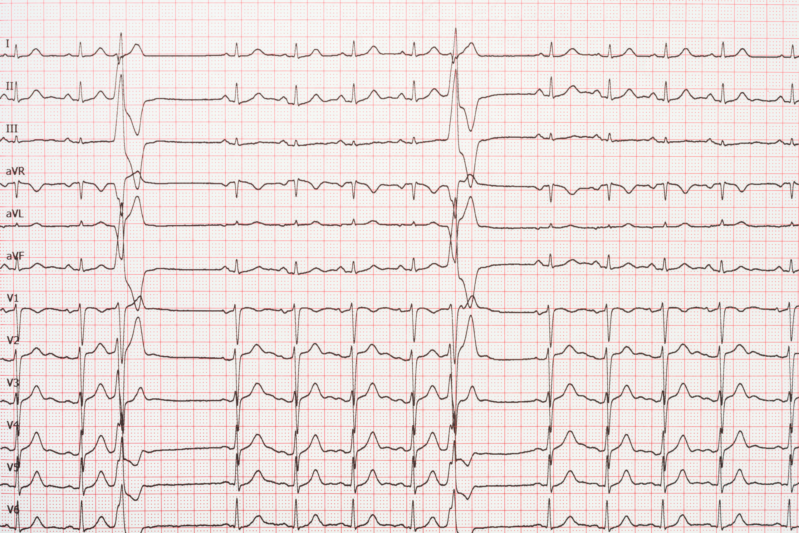 12-lead ECG tracing.