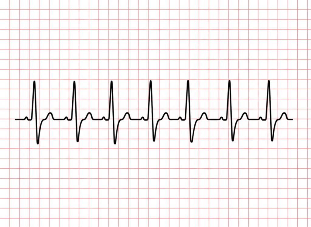 Abnormal notched P wave on ECG indicating atrial conduction abnormality