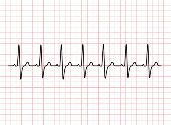 P Wave Pattern EKG & ECG Interpretation Explained | ACLS Certification Association