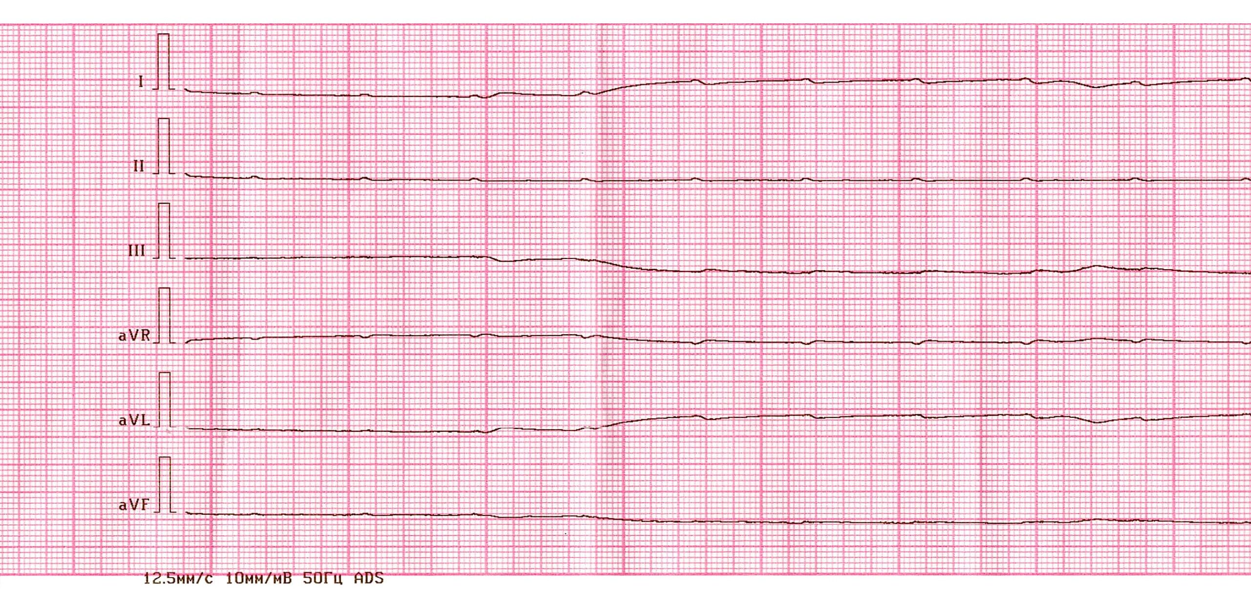 Asystole presents as a flatline on the EKG tracing.