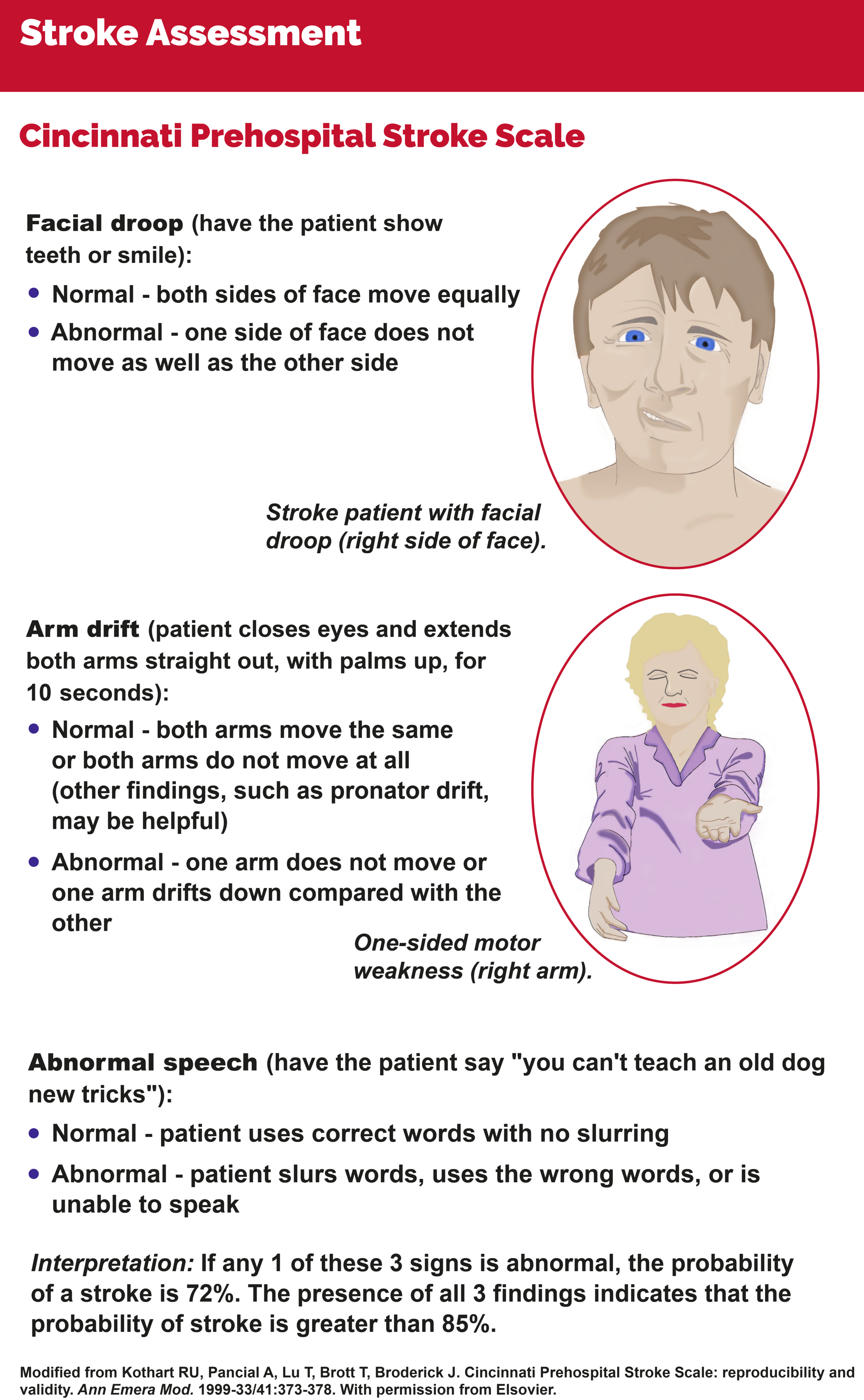 Cincinnati Prehospital Stroke Scale.