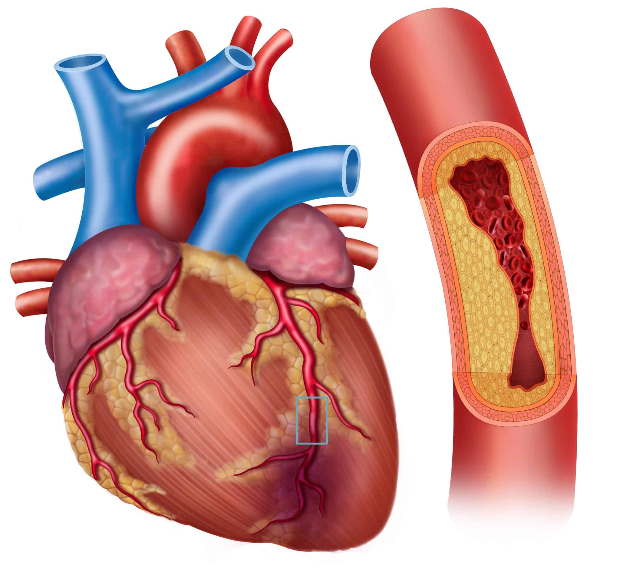 CAD vs PAD: Coronary vs Peripheral Artery Disease