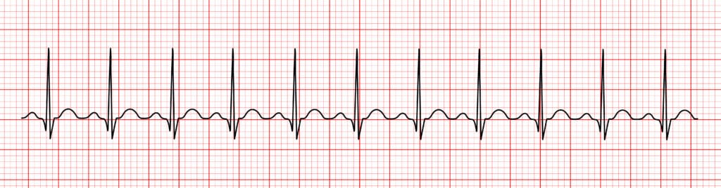 Interpreting an ECG Strip | 12-Lead ECG Resources | ACLS Certification ...