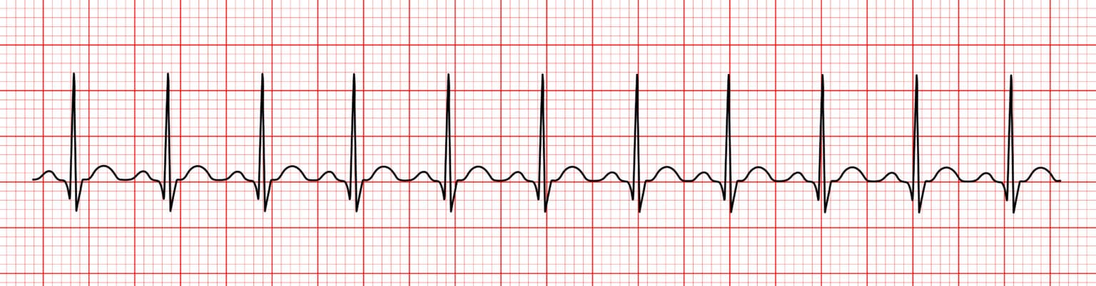 Interpreting an ECG Strip | 12-Lead ECG Resources | ACLS Certification ...