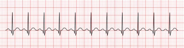 Interpreting an ECG Strip | 12-Lead ECG Resources | ACLS Certification ...