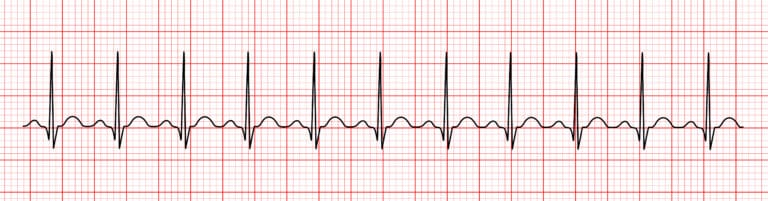 Interpreting an ECG Strip | 12-Lead ECG Resources | ACLS Certification ...