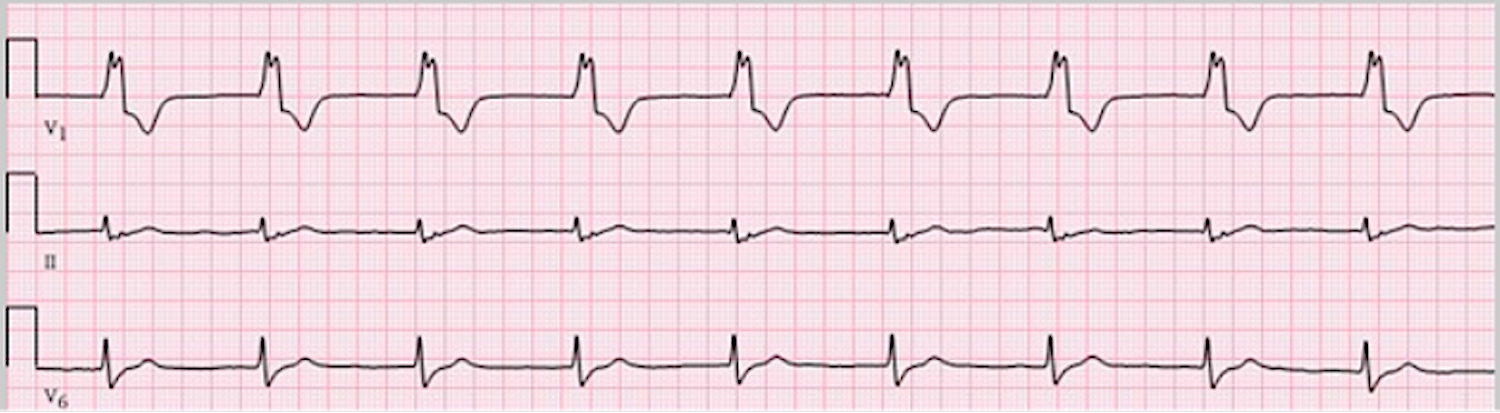 dioventricular rhythm - ECG tracing.