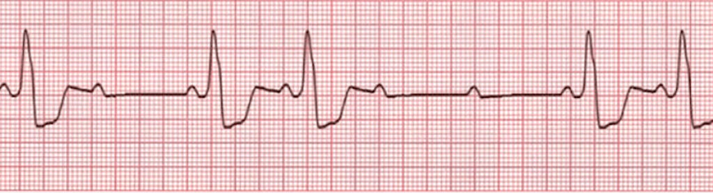 Atrioventricular Block or AV Block | 12-Lead ECG Resources | ACLS ...