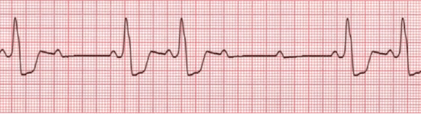 Atrioventricular Blocks (AV Blocks) Explained