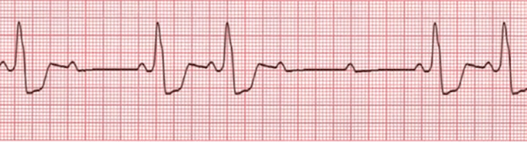 Atrioventricular Block or AV Block | 12-Lead ECG Resources | ACLS ...