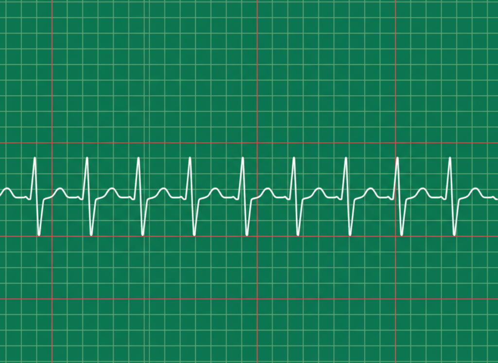 Normal P wave on ECG showing smooth rounded atrial depolarization before each QRS complex