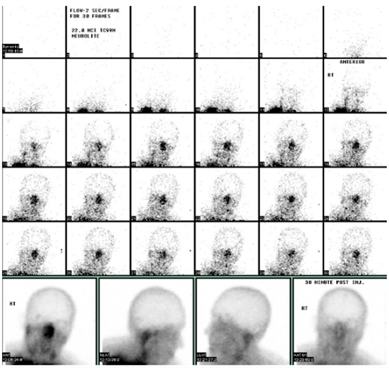 Nuclear SPECT imaging of the brain.
