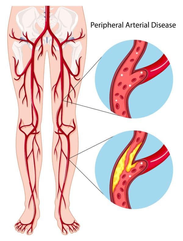 CAD vs PAD: Coronary vs Peripheral Artery Disease