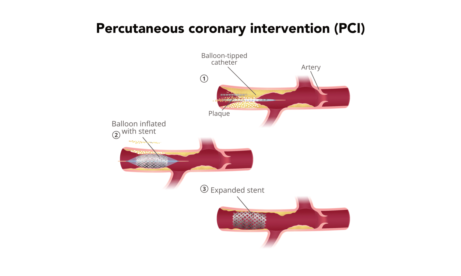 Multiple Pvc Vs Stemi Managing STEMI | ACLS Resources | ACLS Certification Association