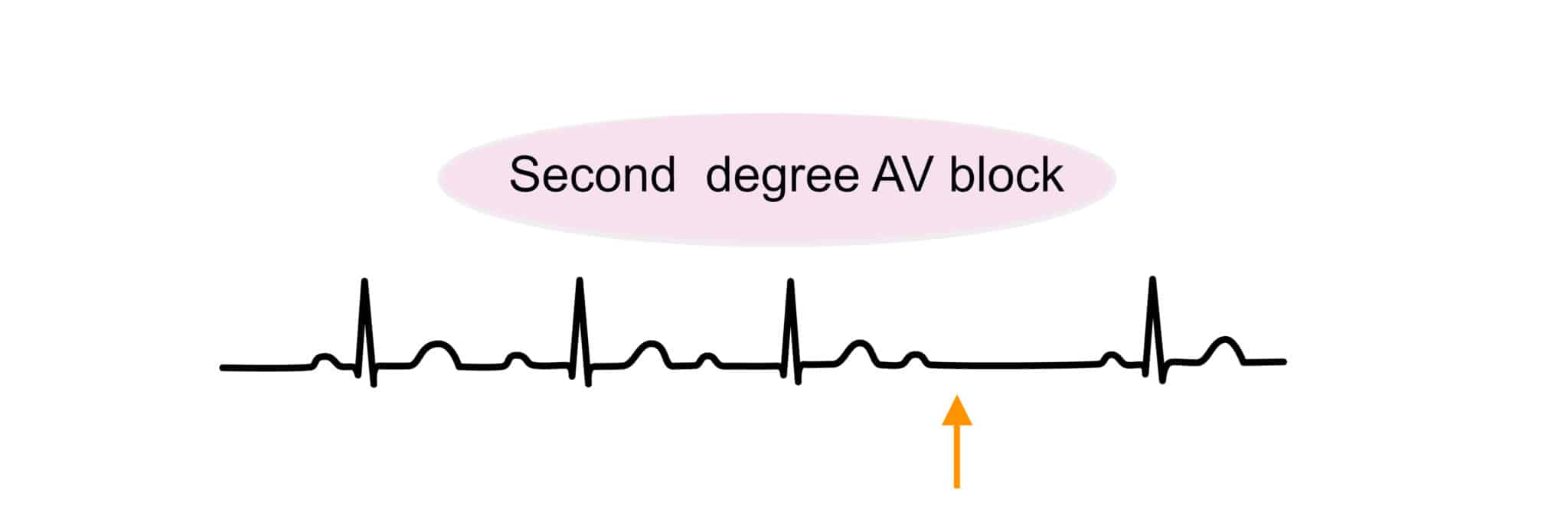 Bradyarrhythmias: ACLS Identification & Treatment Guide
