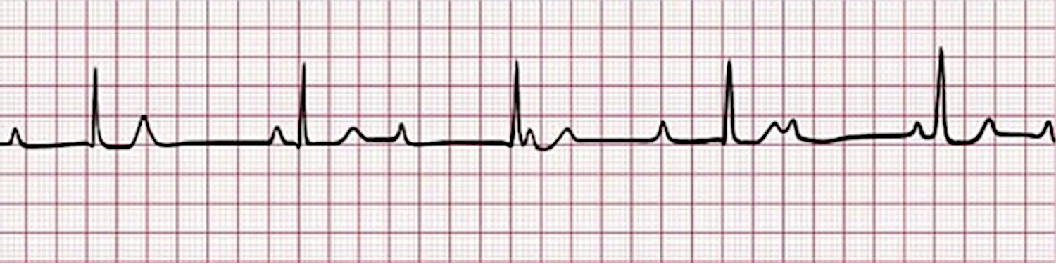 Third-degree AV block - ECG tracing.