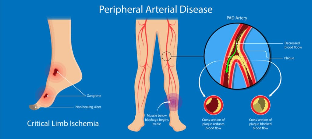 CAD vs PAD: Coronary vs Peripheral Artery Disease