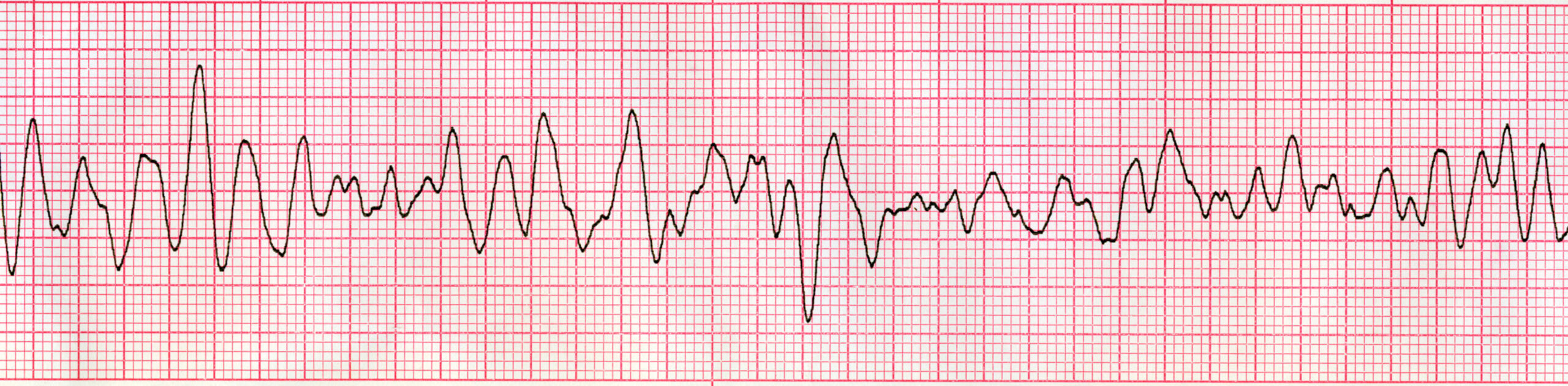 Ventricular fibrillation – ECG tracing.