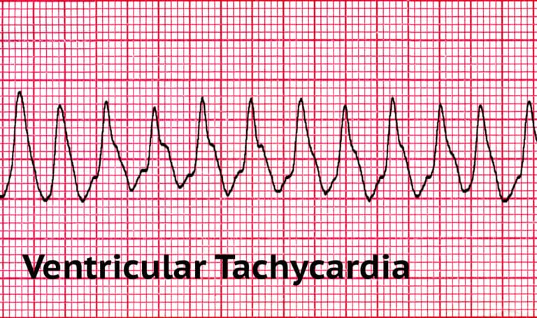 Tachycardia with a Pulse Algorithm Explained | ACLS Resources | ACLS ...