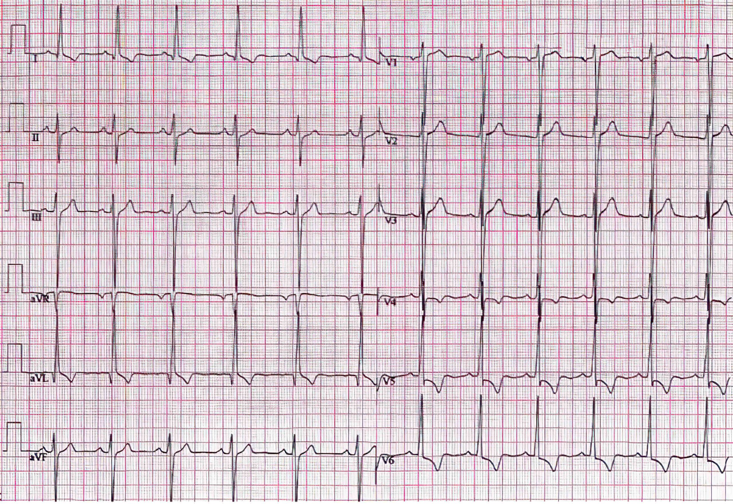 12-lead ECG of 52-year-old man with severe LVH 1 year after aortic valve replacement.