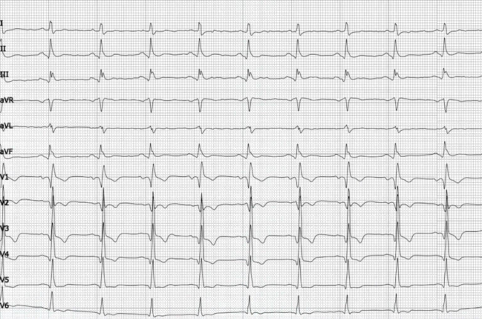 Topic - Complex Infarction Patterns | 12-Lead ECG Certification Course ...