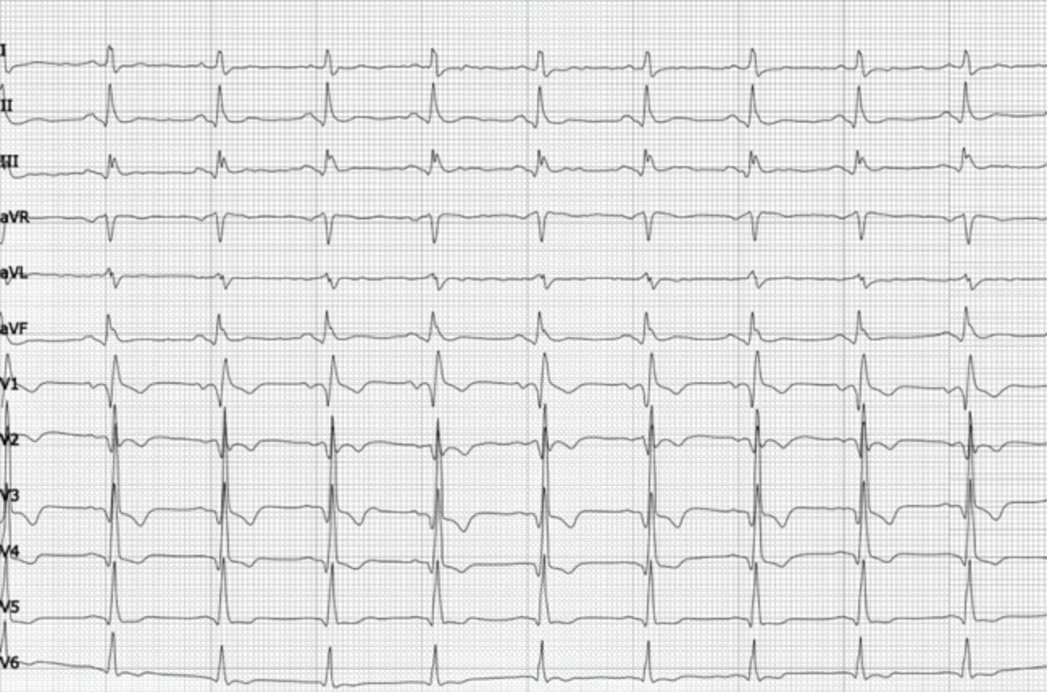 Topic - Complex Infarction Patterns | 12-Lead ECG Certification Course ...
