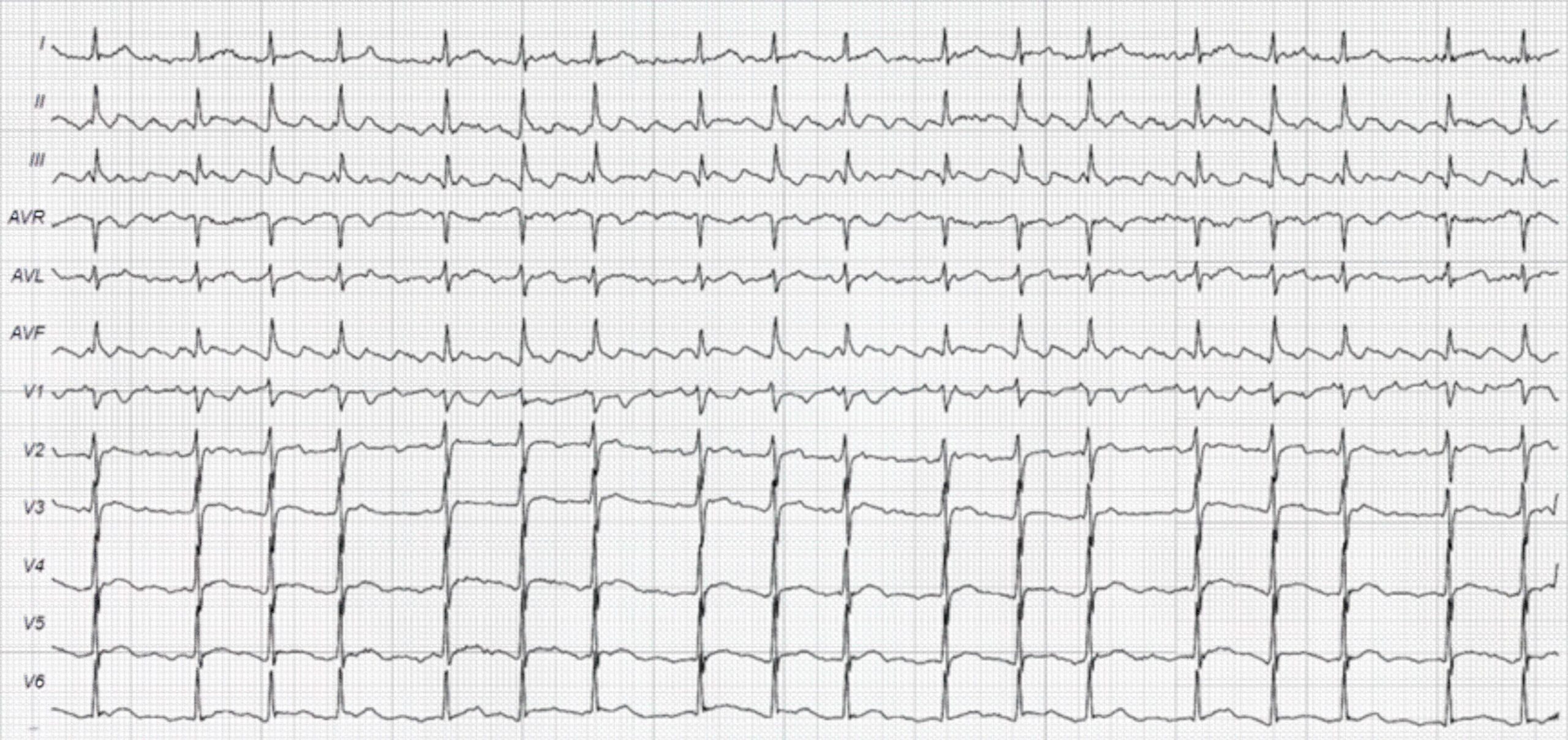 77-year-old man with history of palpitations but otherwise asymptomatic ECG.