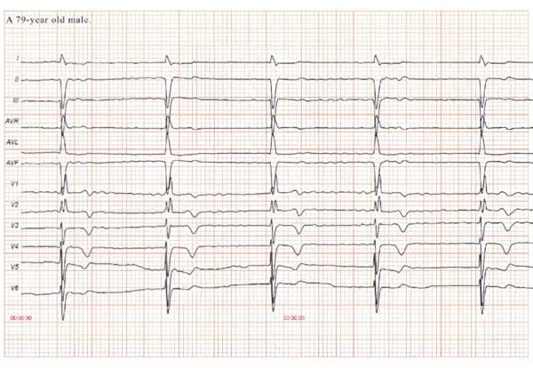 Topic - Incomplete Right Bundle Branch Block | 12-Lead ECG ...