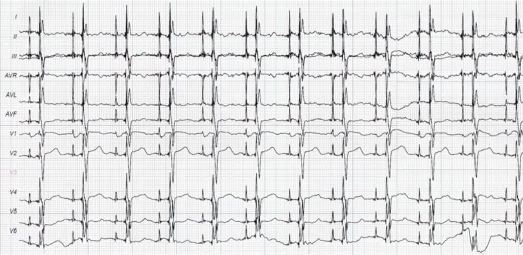 Topic - Double-Chamber Pacemaker | 12-Lead ECG Certification Course ...