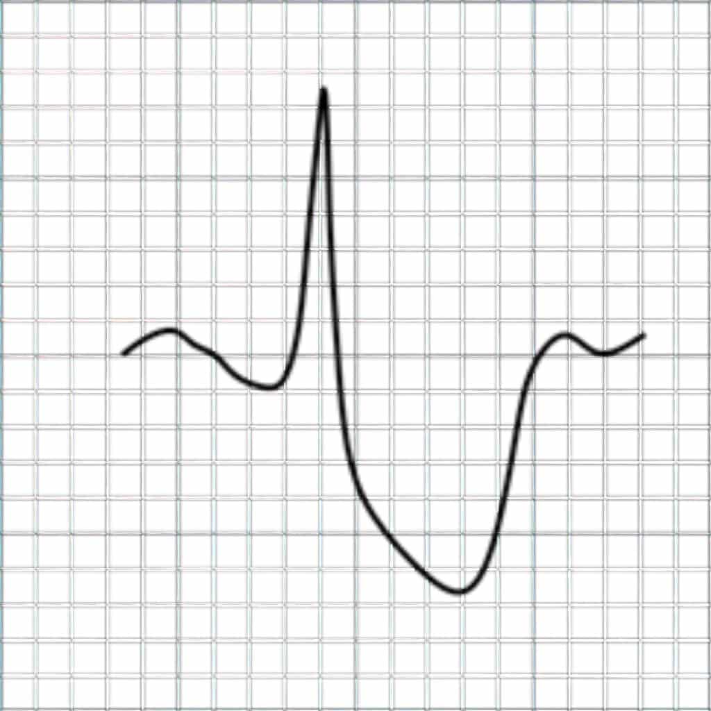 Topic - Special Infarction Patterns | 12-Lead ECG Certification Course ...