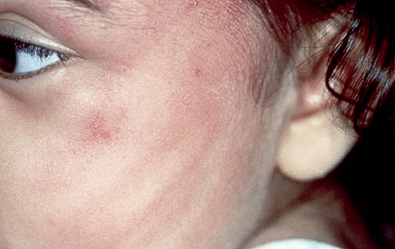 Hand imprint on child’s face.