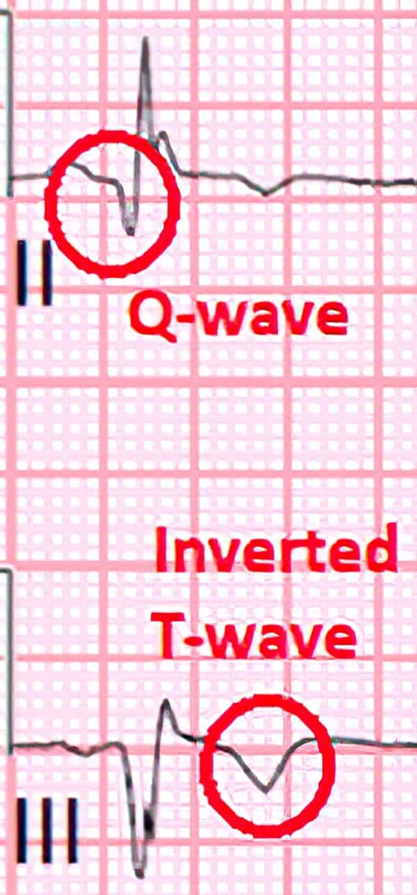 Q Wave Example Topic - Rhythm Analysis | 12-Lead ECG Certification Course | ACLS ...