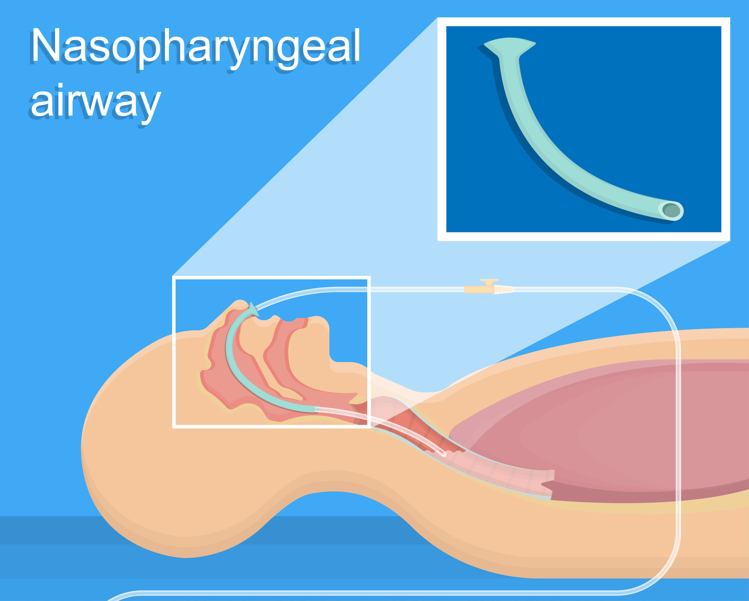 Nasopharyngeal airway insertion.