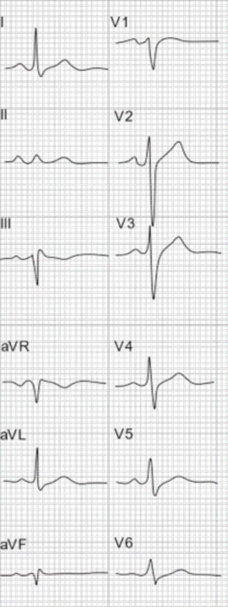 Topic - Hypercalcemia | 12-Lead ECG Certification Course | ACLS ...