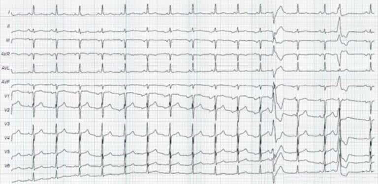 Topic - Morphology and Origin | 12-Lead ECG Certification Course | ACLS ...