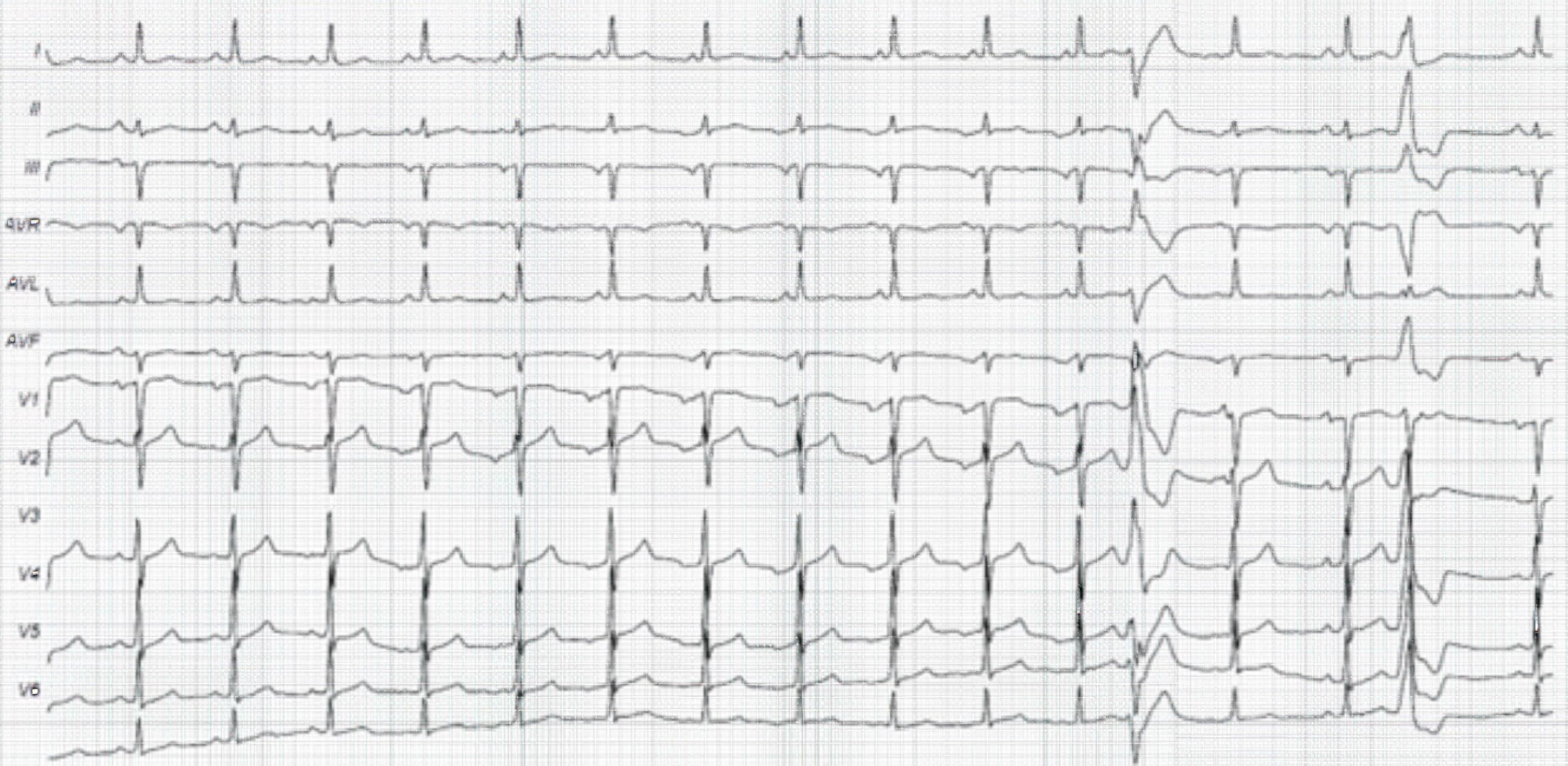 Polymorphic premature ventricular complexes ECG.