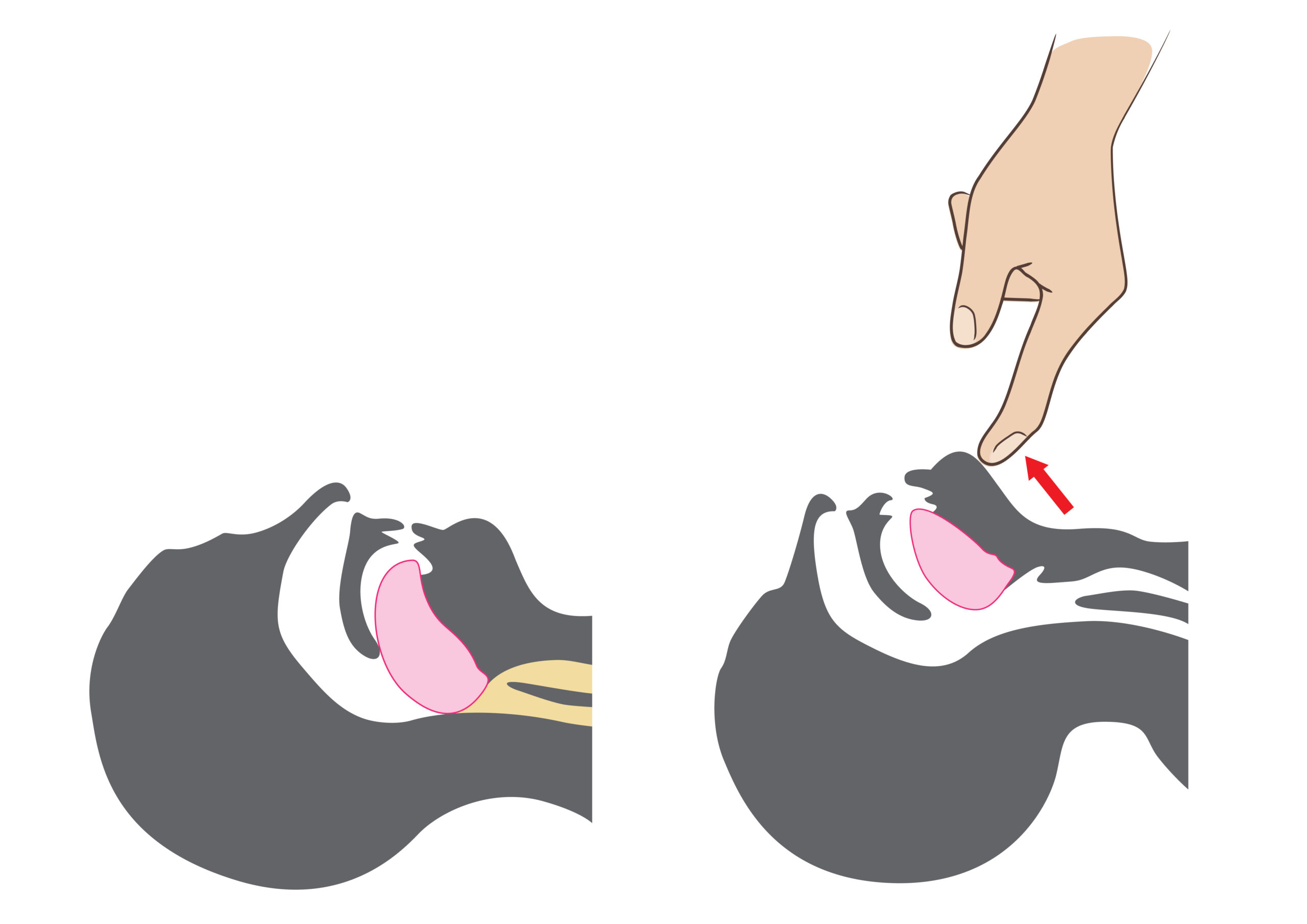 Proper head tilt-chin lift positioning illustration.