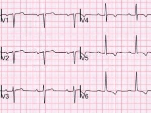 Topic - The QRS Complex | 12-Lead ECG Certification Course | ACLS ...